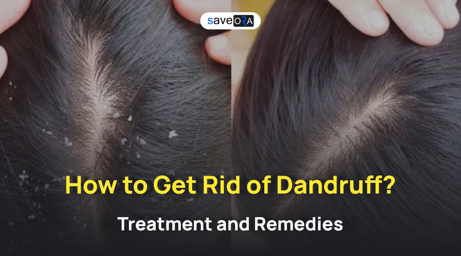 How to Get Rid of Dandruff_ Treatment and Remedies
